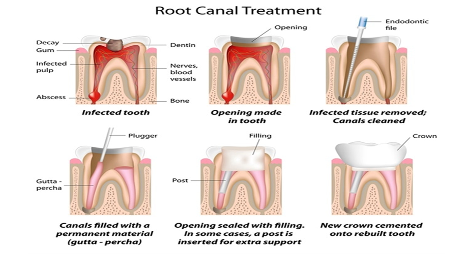 Root Canal Treatment ​