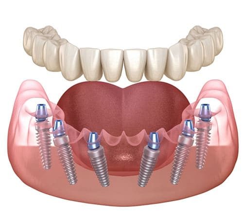 DENTAL IMPLANT IN 72 HOURS
