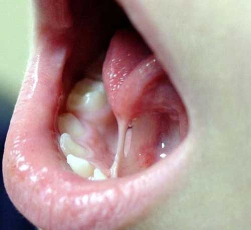 Frenectomy