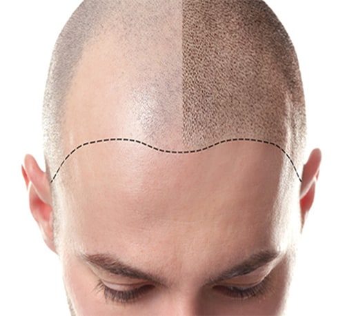 mesotherapy FOR HAIR LOSS